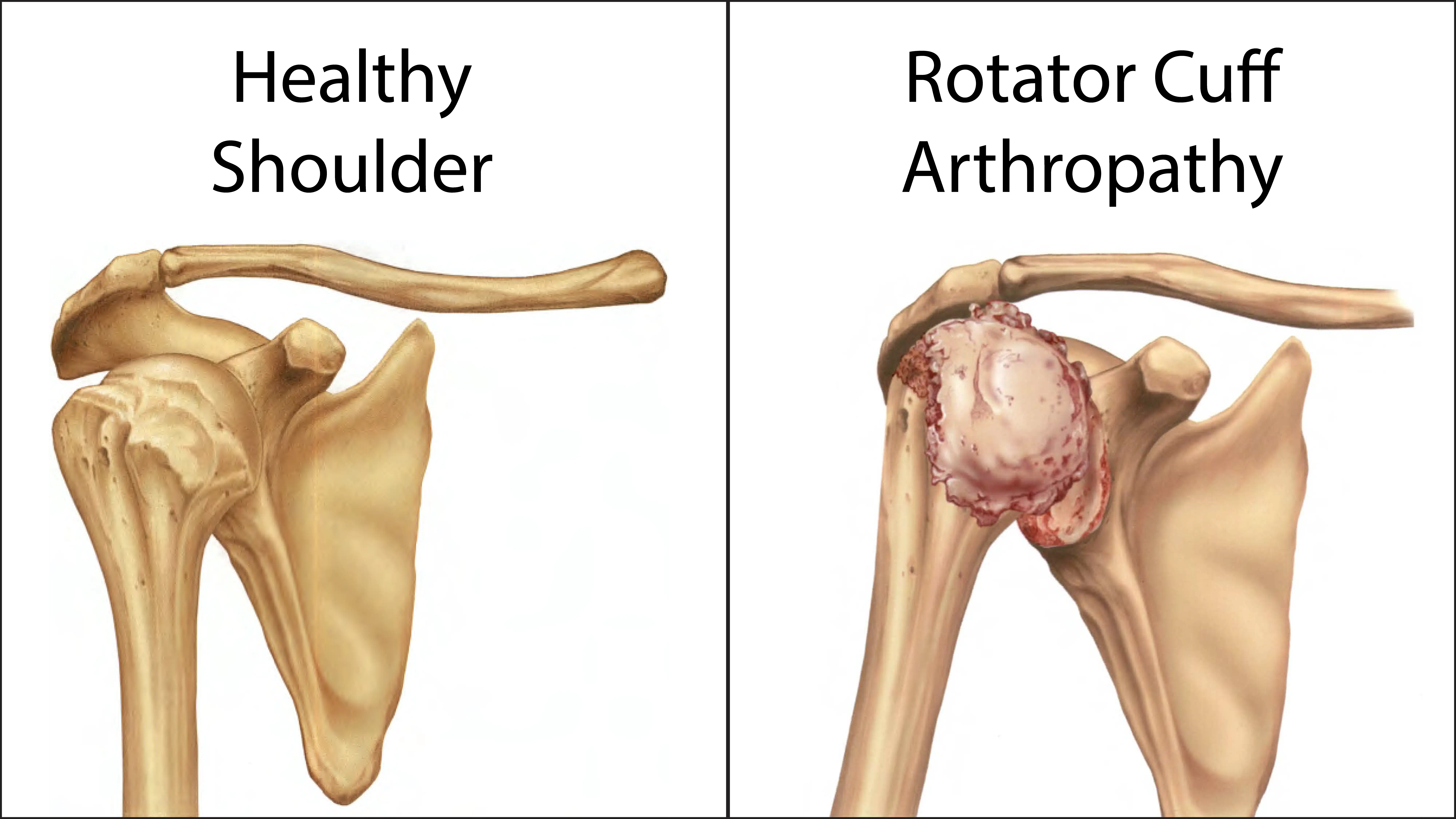 Anatomy of Rotator Cuff Arthropathy