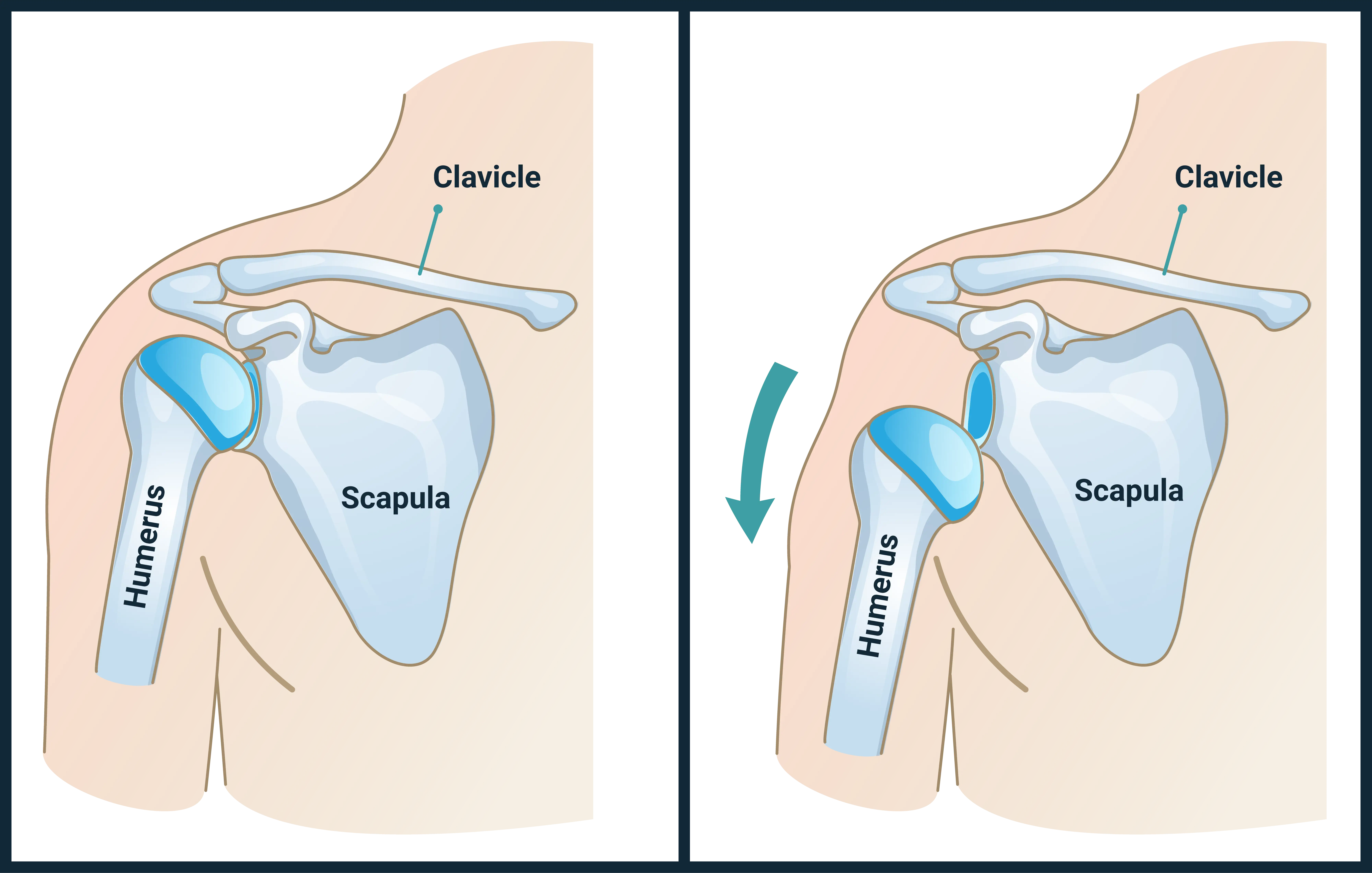 Anatomical Graphic of Shoulder Dislocations