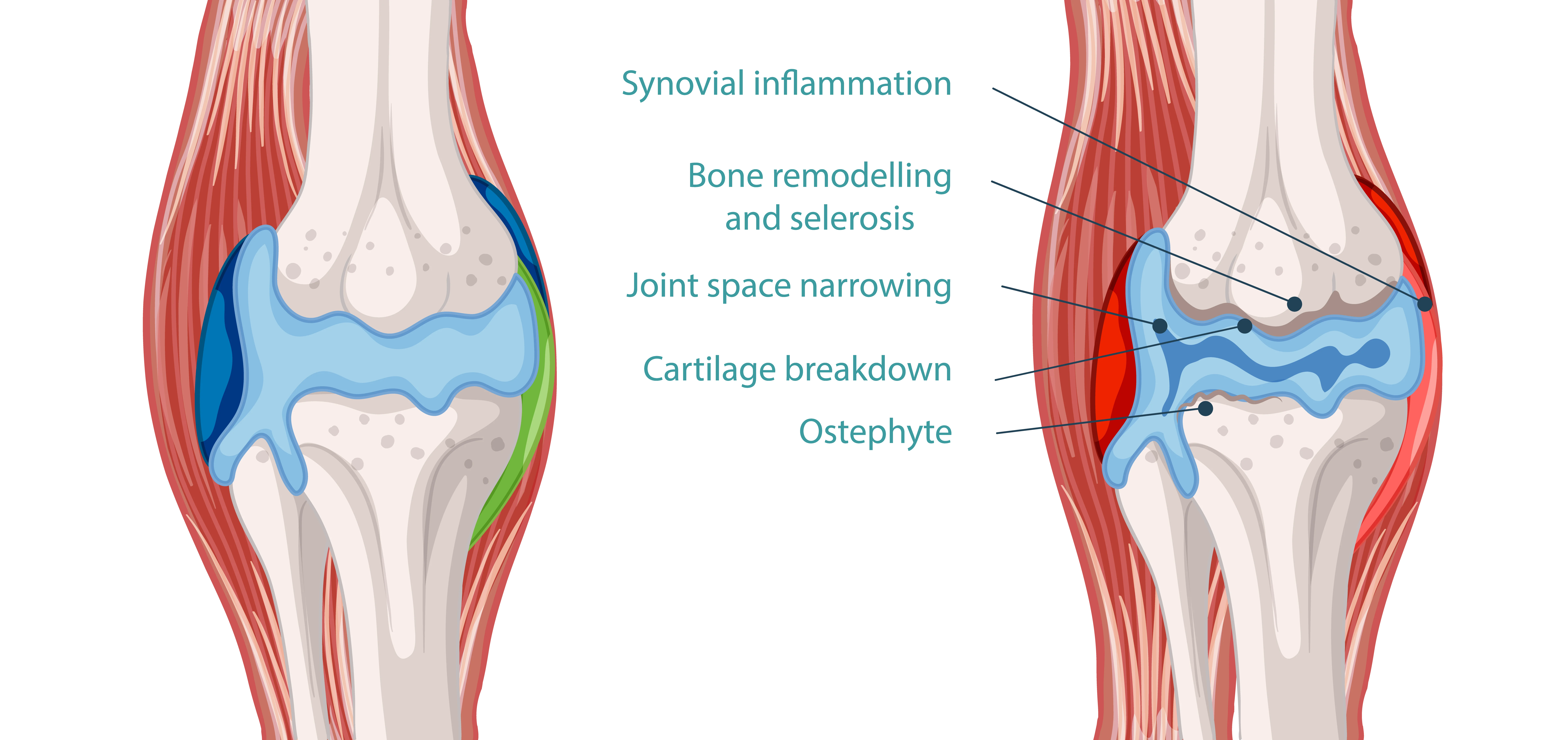 Anatomical Graphic of Elbow Arthritis