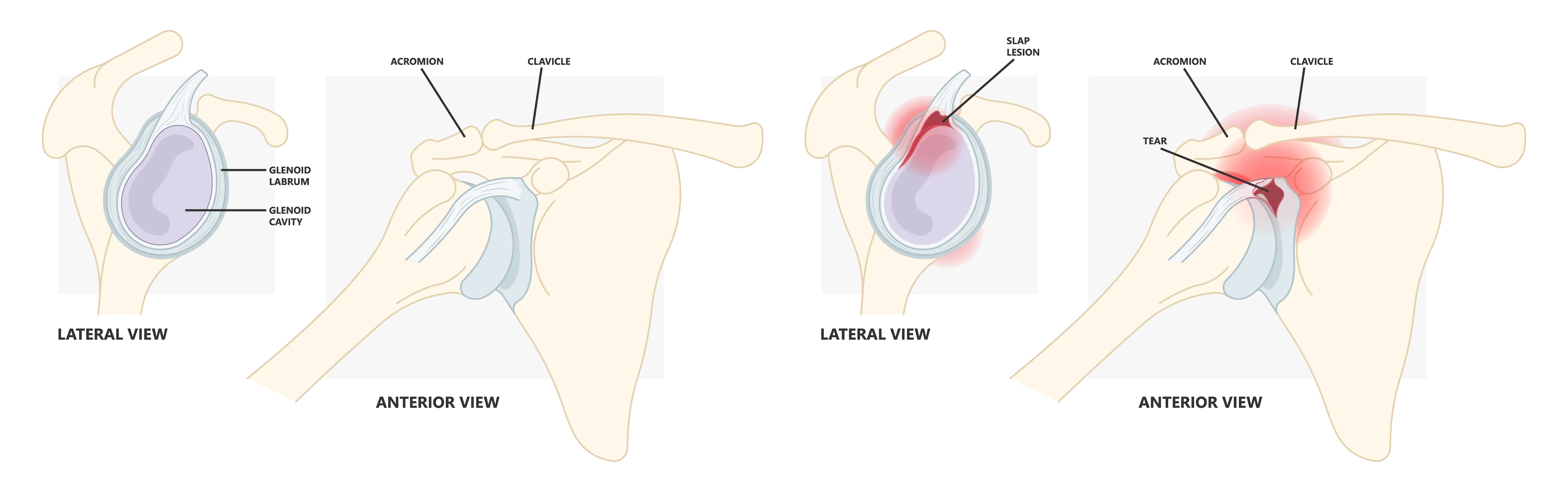 Slap Tear