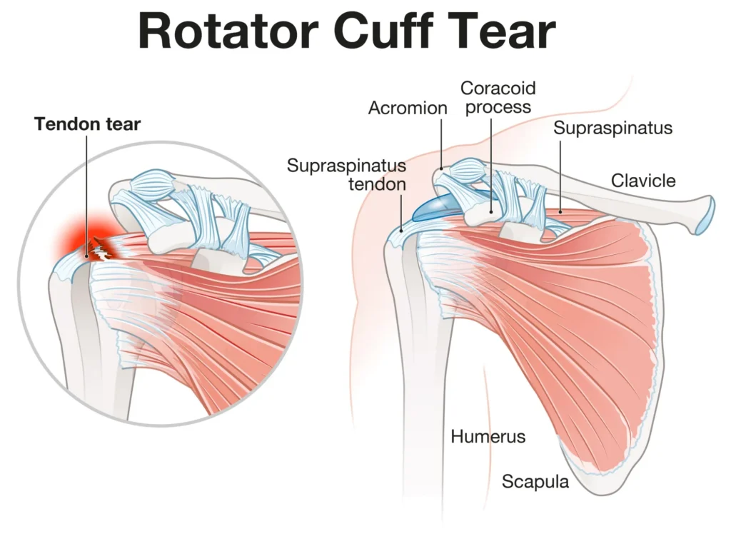 rotator cuff tear diagram comparing a healthy shoulder to a shoulder with a rotator cuff tear.