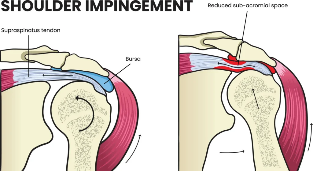 Anatomical diagram of a healthy shoulder compared to one impacted by shoulder impingement syndrome.