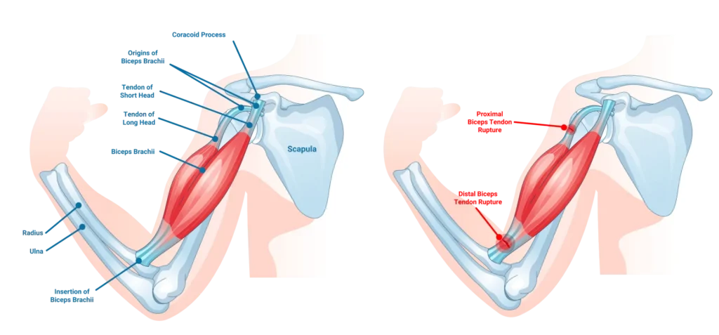 Proximal Biceps Tendon Tears near the shoulder
