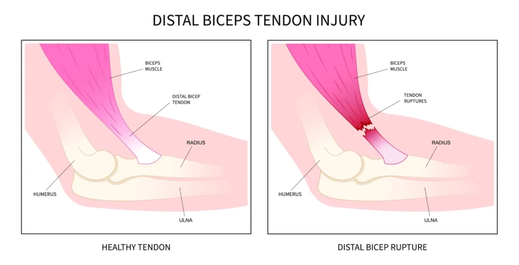 Diagram of healthy biceps tendon and a distal biceps tendon tear.