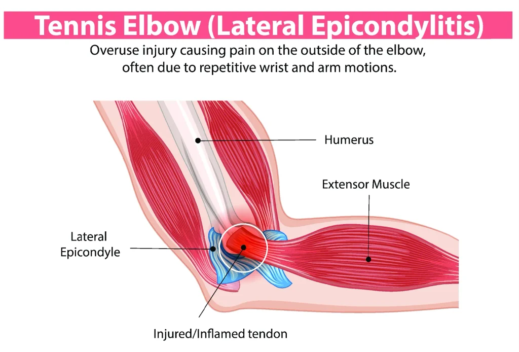 Diagram of tennis elbow.