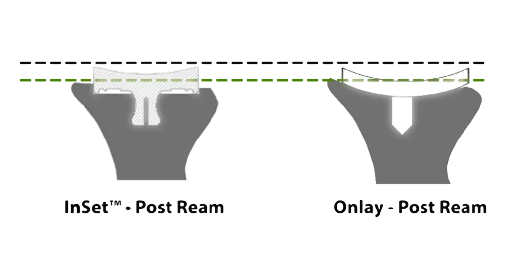 Onlay vs. Inlay Glenoid diagram