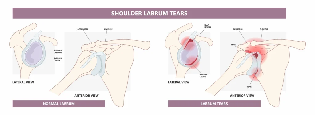 Shoulder labrum versus shoulder labrum tear diagram 
