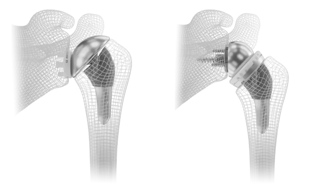 Total shoulder replacement implant and reverse shoulder replacement implant 