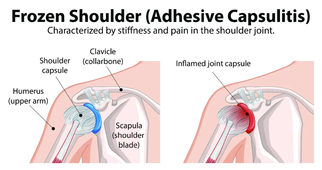 Diagram of frozen shoulder
