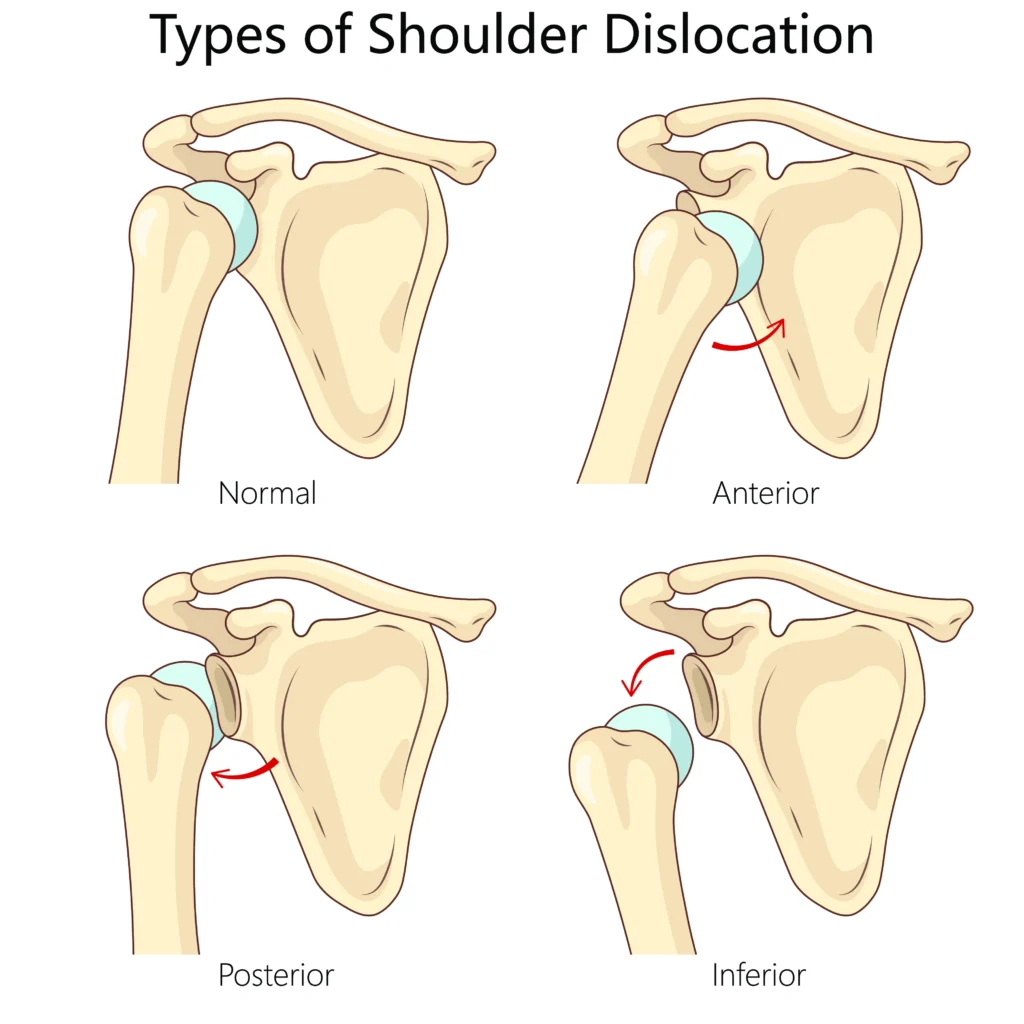 Different types of shoulder dislocations 